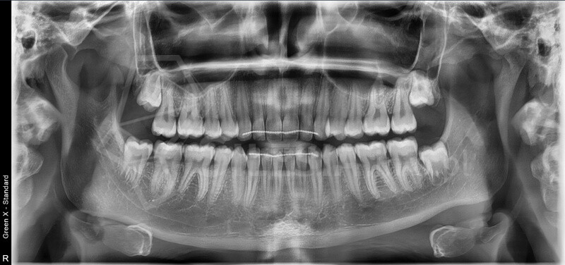 RTG i tomografia CBCT od 100 zł – Świętochłowice